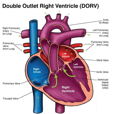 double outlet left ventricle repair